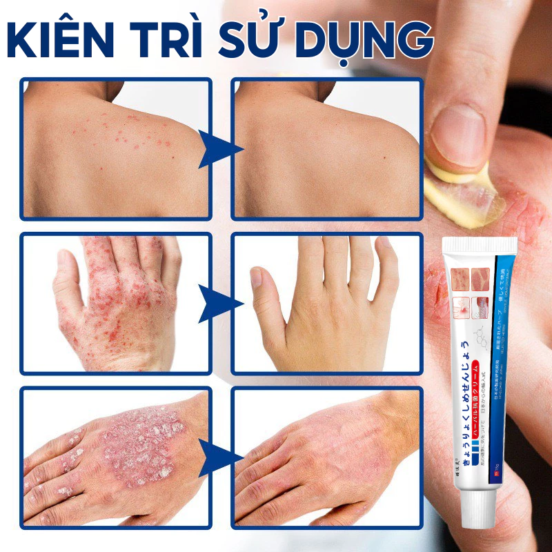 Kem Bôi Viêm Da Cơ Địa NHẬT BẢN Hỗ Trợ Dứt Điểm Lác Đồng Tiền, Nấm Da Đầu, Ghẻ Nước, Á Sừng Cực Kì Hiệu Quả - 5
