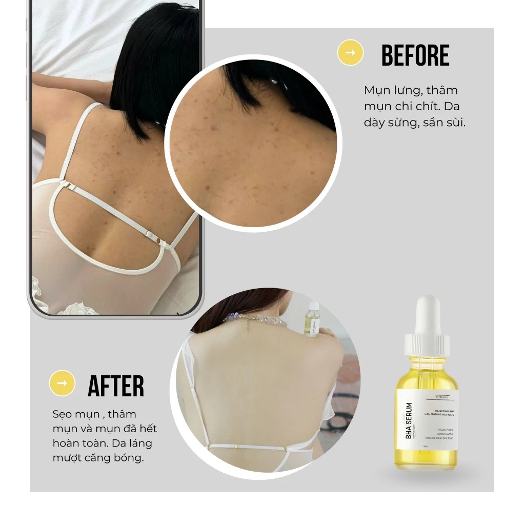 BHA Serum 8%15ml ND giảm mụn Face & Body,giảm viêm nang lông,thu nhỏ lỗ chân lông,tẩy tế bào chết,.. - 5