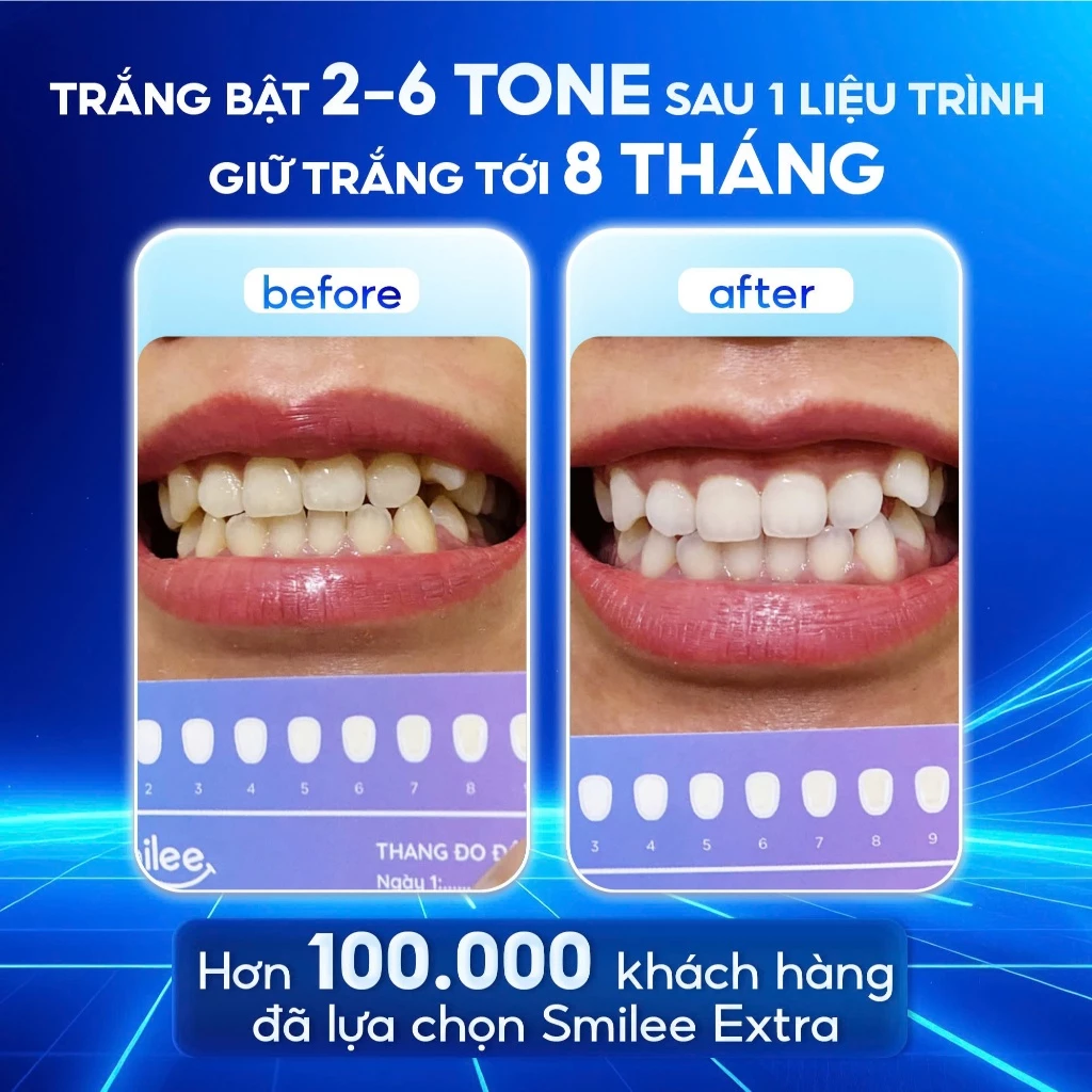 [GIÁ 654K LIVE ECOGO] Bộ Kit Trắng Răng Smilee Extra, làm trắng răng tại nhà Phiên Bản Nâng Cấp Làm Trắng Nh - 6