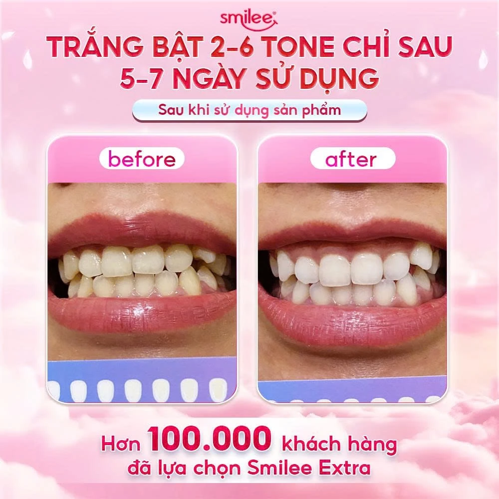 [GIÁ 638K LIVE ECOGO] Bộ Kit Trắng Răng Smilee Extra, Làm Trắng Răng Bật 2-6 Tone Tại Nhà Phiên Bản Nâng Cấp