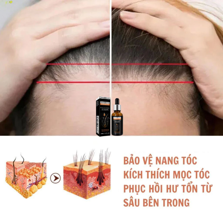 Serum Tinh Chất Mọc Tóc Giảm Gàu , Thảo Dược Kích Thích Mọc Tóc Giảm Nấm Ngứa, Giúp Tóc Chắc Và Khoẻ - 3