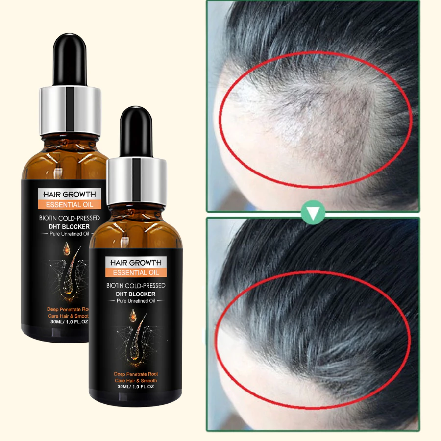 Serum Tinh Chất Mọc Tóc Giảm Gàu , Thảo Dược Kích Thích Mọc Tóc Giảm Nấm Ngứa, Giúp Tóc Chắc Và Khoẻ - 4