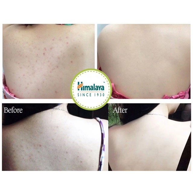 [KOL x Himalaya] SET 6 xà phòng làm sạch da Himalaya Neem Soap 75g/ sản phẩm - 4