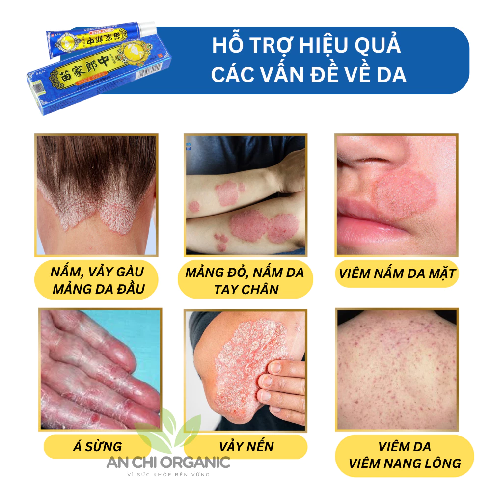 Kem Bôi Nấm Ngứa Hỗ Trợ Hắc Lào, Vẩy Nến, Á Sừng , Lang Ben Bà Lão Xanh Dương 15g An Chi Organic - 2
