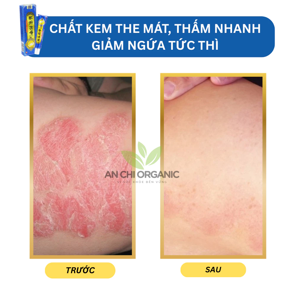 Kem Bôi Nấm Ngứa Hỗ Trợ Hắc Lào, Vẩy Nến, Á Sừng , Lang Ben Bà Lão Xanh Dương 15g An Chi Organic - 3