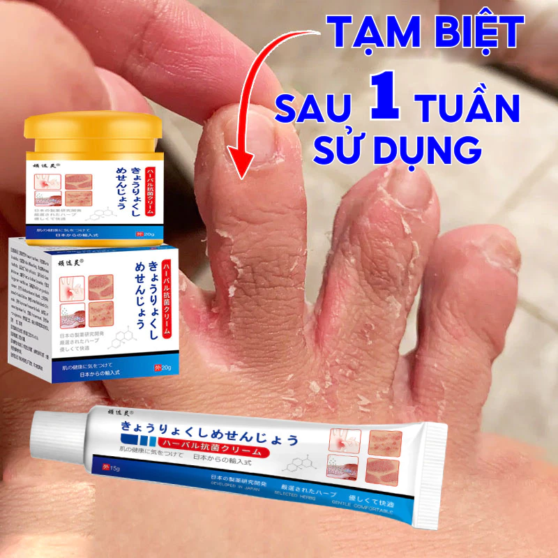 Kem Bôi Da NHẬT BẢN Dứt Điểm Viêm Da Cơ Địa Nấm Ngứa, Hắc Lào, Tổ Đỉa, Ghẻ Nước Cực Kì Hiệu Quả - 2