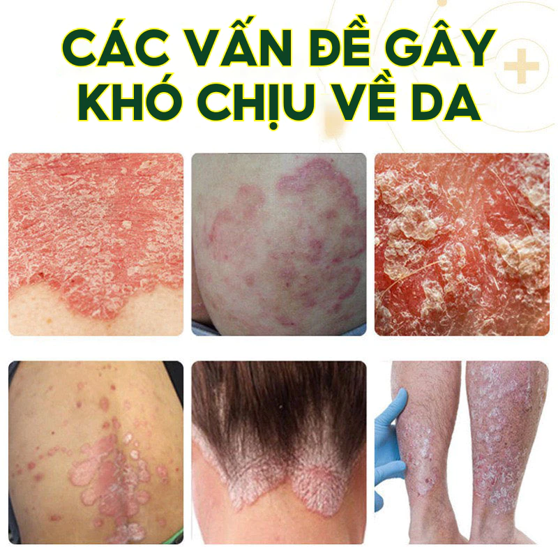 Kem Bôi Da NHẬT BẢN Dứt Điểm Viêm Da Cơ Địa Nấm Ngứa, Hắc Lào, Tổ Đỉa, Ghẻ Nước Cực Kì Hiệu Quả - 4