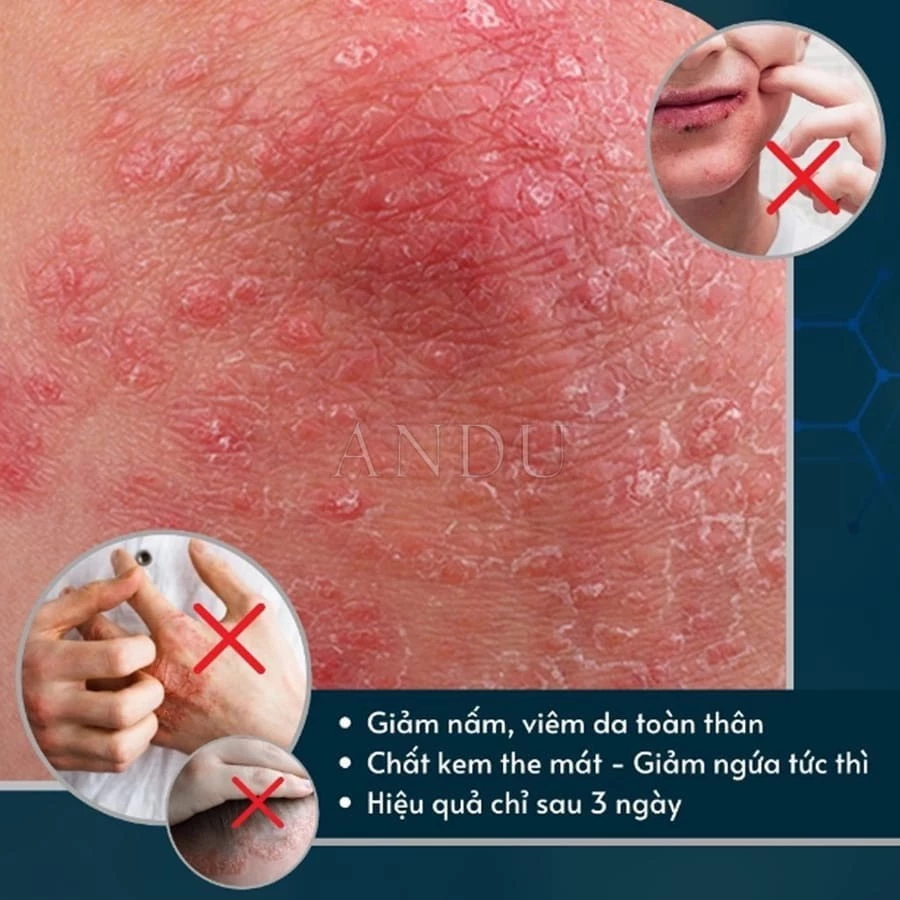 Kem Bôi Viêm Da Cơ Địa NHẬT BẢN Hỗ Trợ Dứt Điểm Lác Đồng Tiền, Nấm Da Đầu, Ghẻ Nước, Á Sừng Cực Kì Hiệu Quả - 3