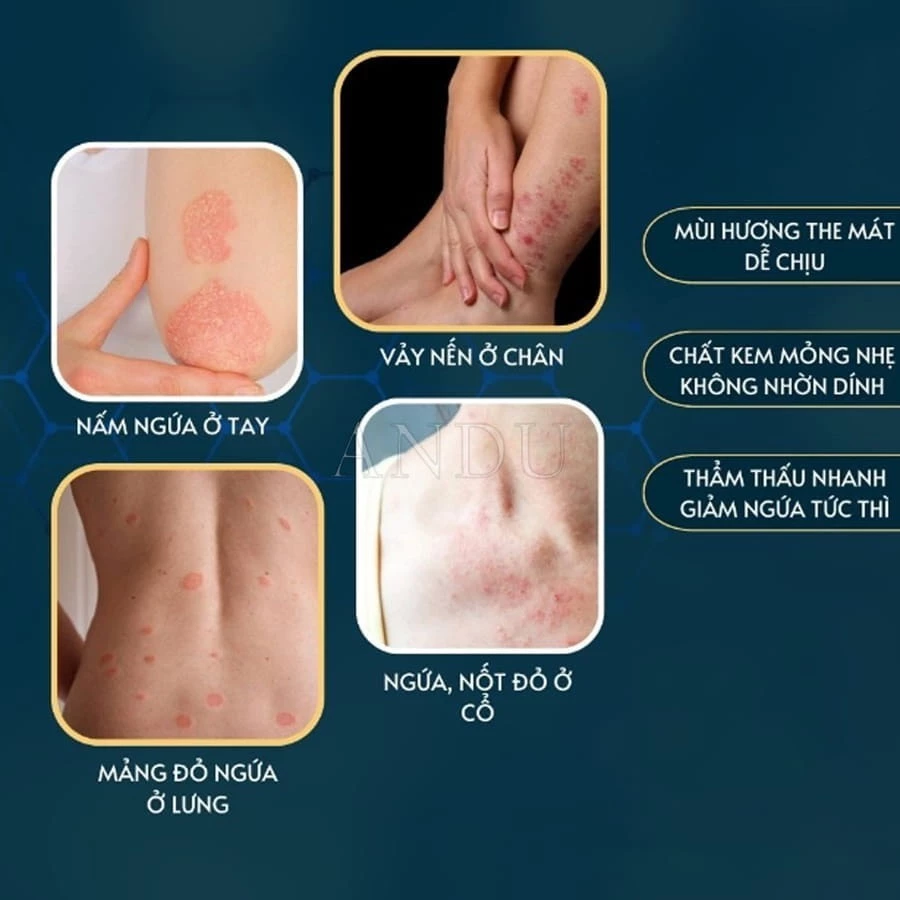 Kem Bôi Viêm Da Cơ Địa NHẬT BẢN Hỗ Trợ Dứt Điểm Lác Đồng Tiền, Nấm Da Đầu, Ghẻ Nước, Á Sừng Cực Kì Hiệu Quả - 4