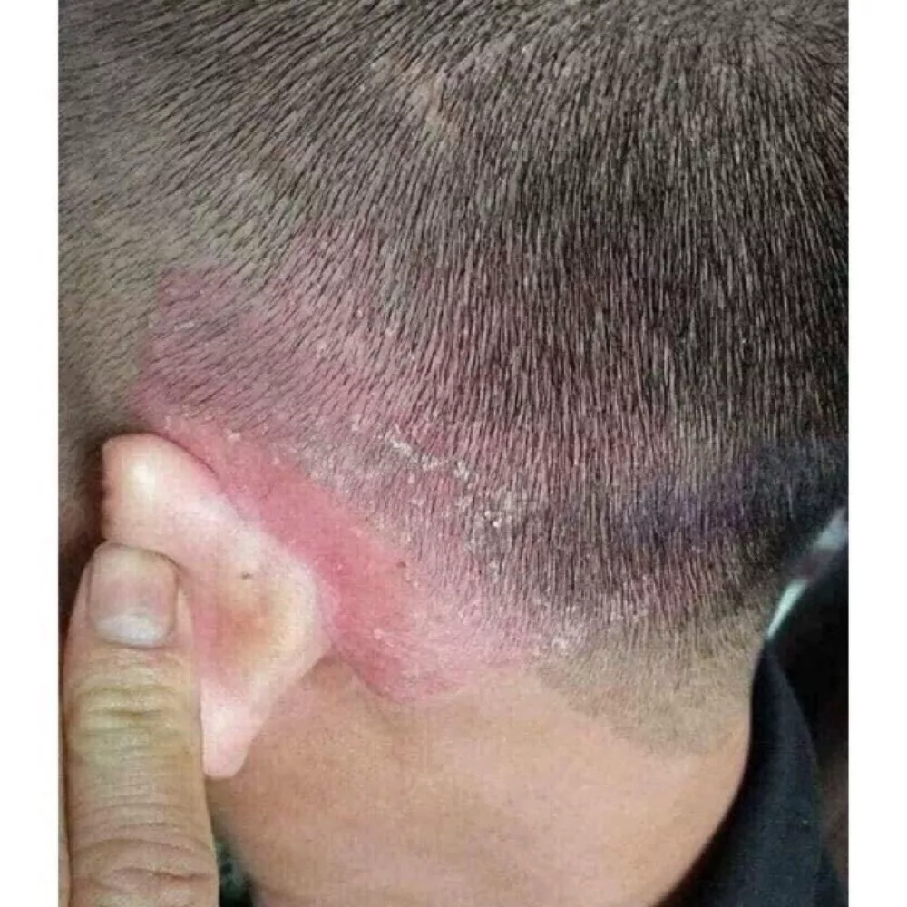 Kem Bôi Ngứa Vảy Nến Thái Lan Clinoderm Cream 15g Hỗ Trợ Viêm Da Cơ Địa, Tổ Đỉa, Nước Ăn Tay Chân - 3