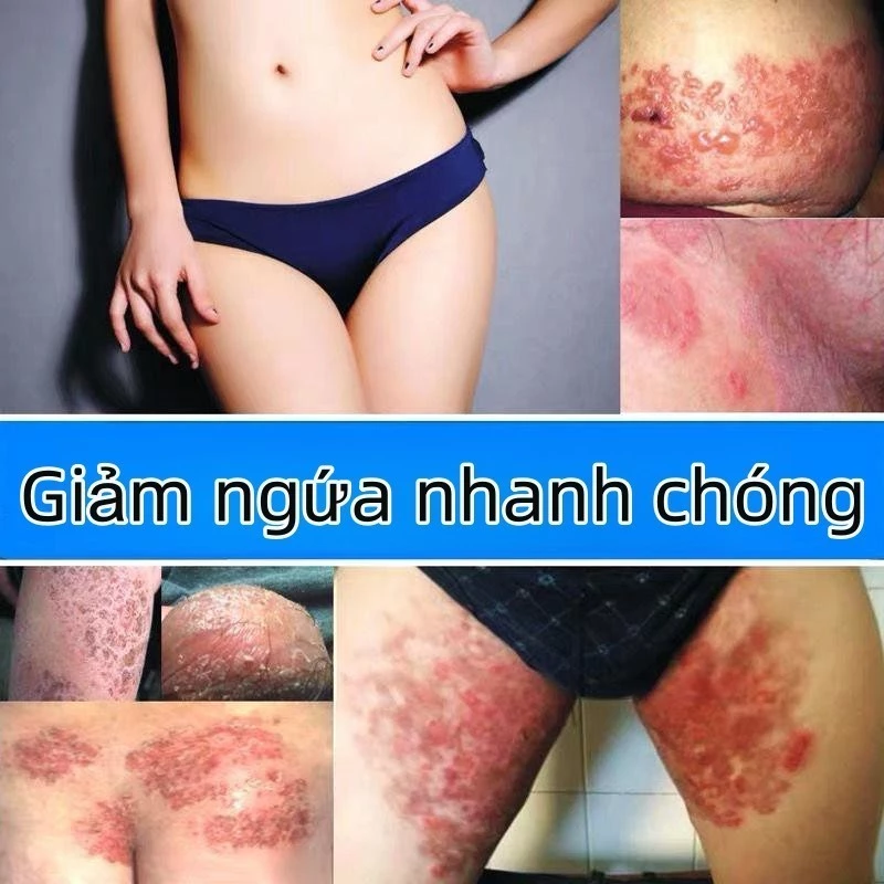 Kem Bôi Nấm Ngứa Viêm Da Cơ Địa NHẬT BẢN Hắc Lào, Tổ Đỉa, Vẩy Nến, Á Sừng, Lang Ben Hiệu Quả - 3