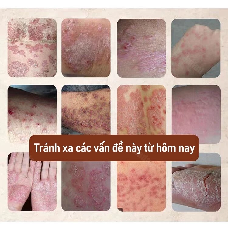 Kem Bôi Nấm Ngứa Viêm Da Cơ Địa NHẬT BẢN Hắc Lào, Tổ Đỉa, Vẩy Nến, Á Sừng, Lang Ben Hiệu Quả - 4