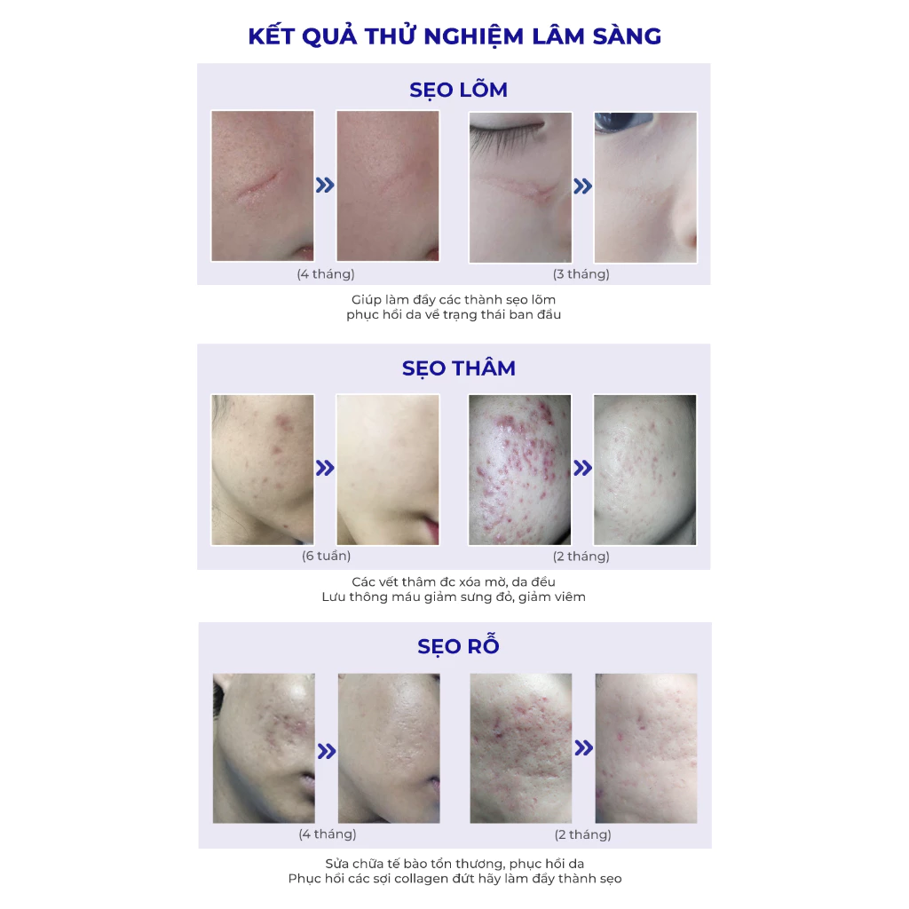 Kem Xóa Sạch Sẹo Thâm, lấp đầy Sẹo Rỗ, Sẹo Lõm Scar Esthetique 10ml của Rejuvaskin - 6