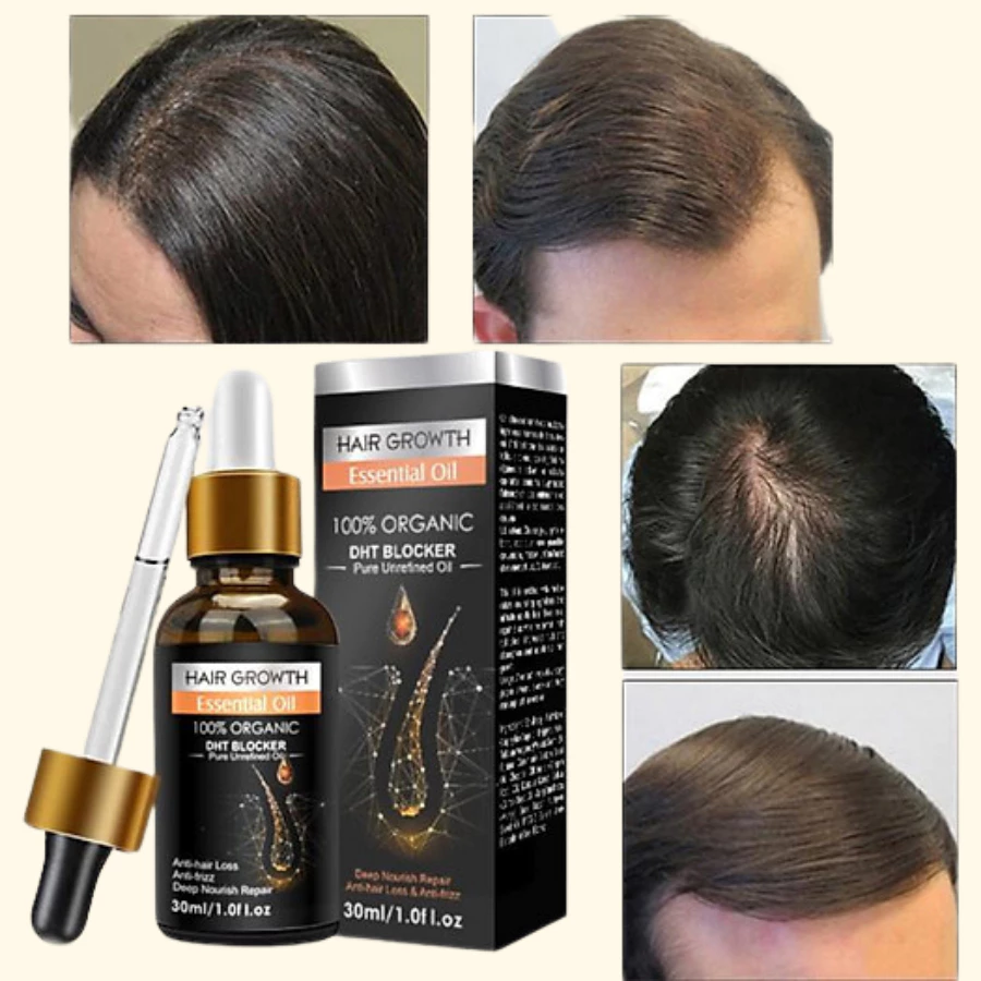 Serum Tinh Chất Mọc Tóc Giảm Gàu , Thảo Dược Kích Thích Mọc Tóc Giảm Nấm Ngứa, Giúp Tóc Chắc Và Khoẻ - 5